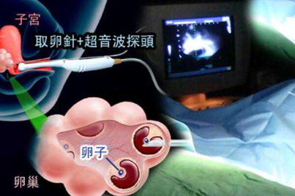 台湾可以做供卵试管婴儿吗,试管婴儿移植成功后为什么要做几次B超检查？-hp