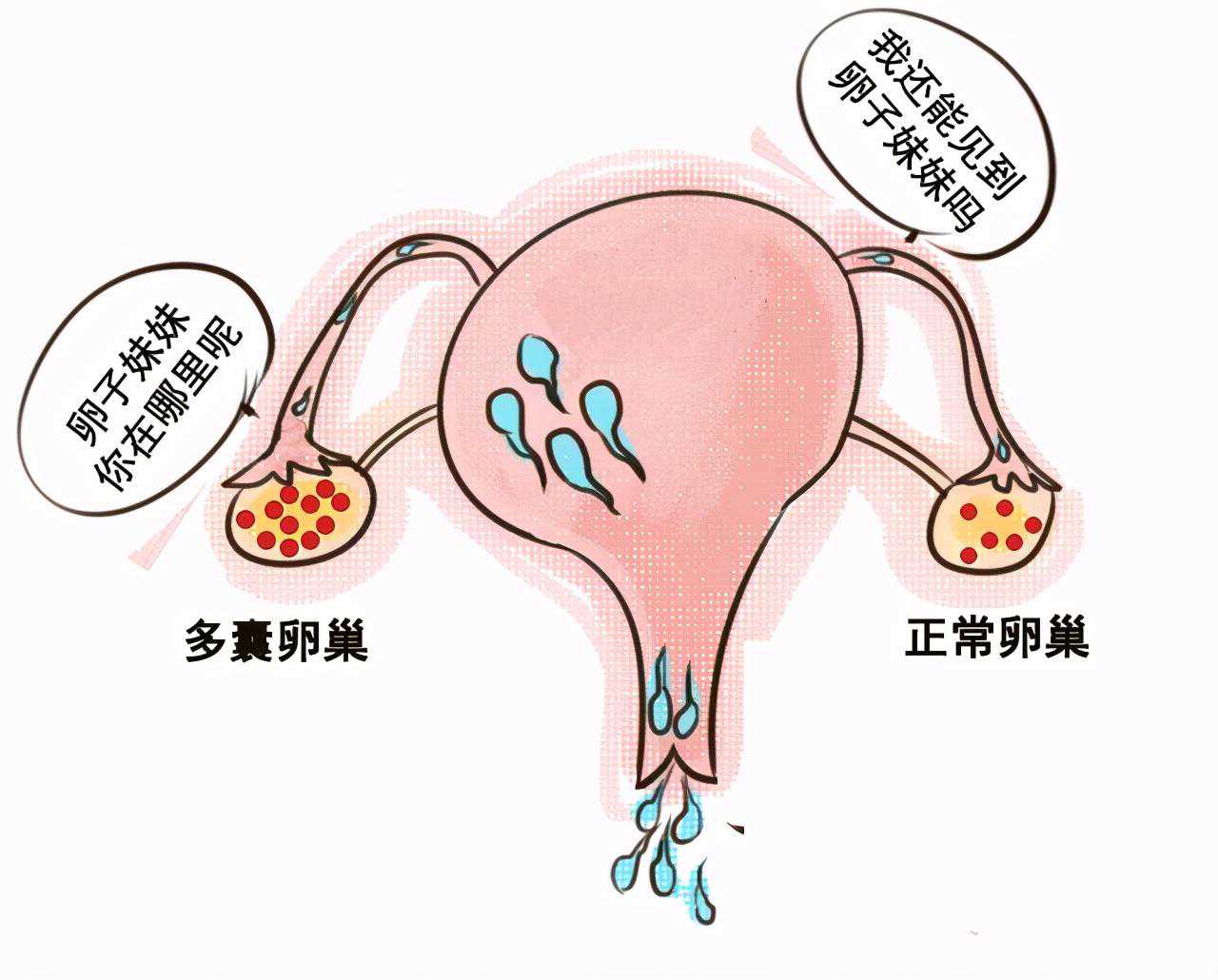 (a)代孕生殖中心怀孕妈妈,多囊卵巢备孕吃二甲双胍，调节胰岛素水平健康怀孕